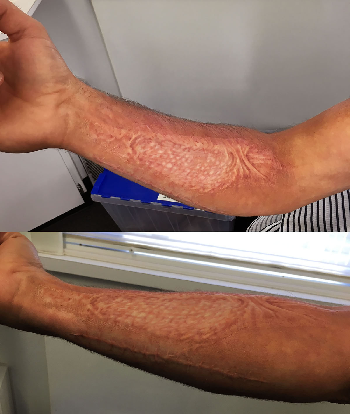 Skin graft appliances for the series 'NCIS-Los Angeles'